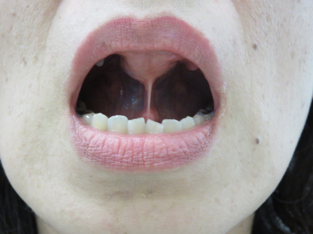 あなたの舌は どこにおいてますか 正しい舌の位置 広島県呉市の歯医者なら記念歯科
