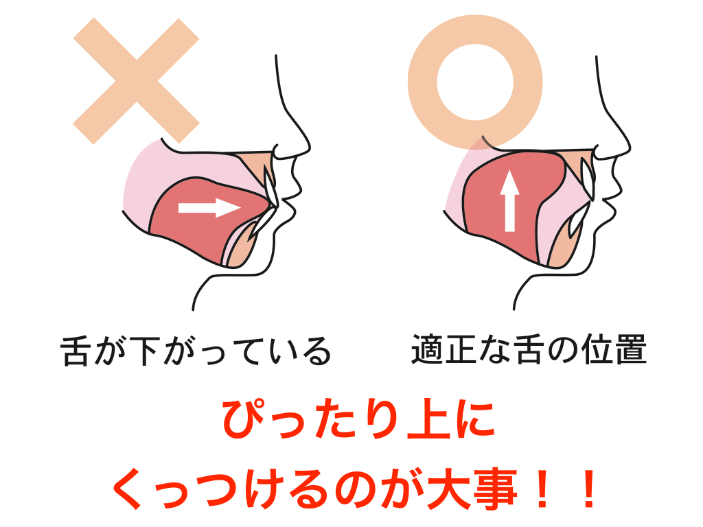 あなたの舌は どこにおいてますか 正しい舌の位置 広島県呉市の歯医者なら記念歯科